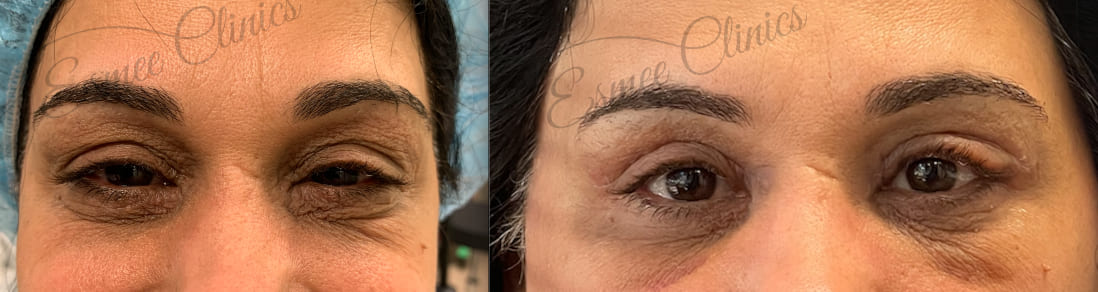 Before and After img